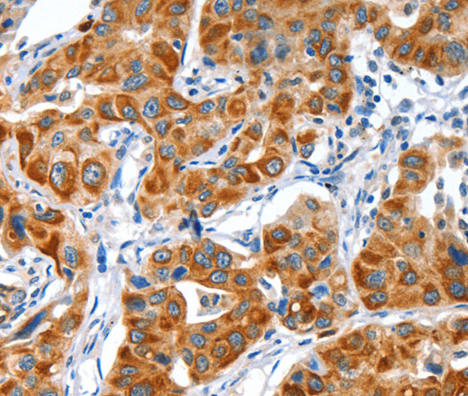 Immunohistochemistry of paraffin-embedded Human lung cancer tissue using VWA5A Polyclonal Antibody at dilution 1:80