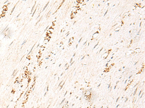 Immunohistochemistry of paraffin-embedded Human colorectal cancer tissue  using MDFI Polyclonal Antibody at dilution of 1:50(?200)