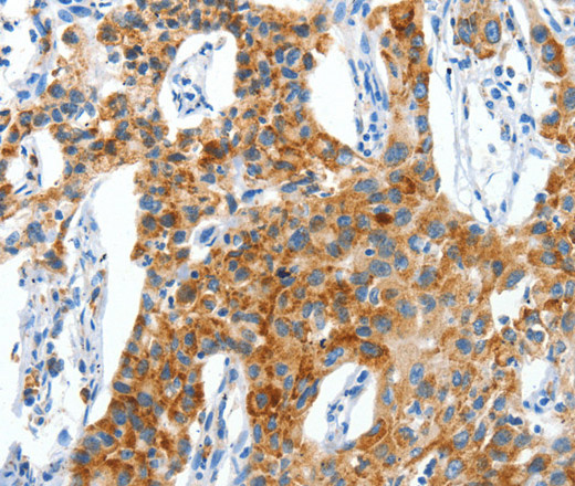 Immunohistochemistry of paraffin-embedded Human lung cancer using CKAP4 Polyclonal Antibody at dilution of 1:50