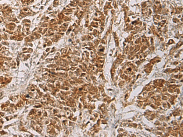 Immunohistochemistry of paraffin-embedded Human colorectal cancer tissue  using HOXC5 Polyclonal Antibody at dilution of 1:55(?200)