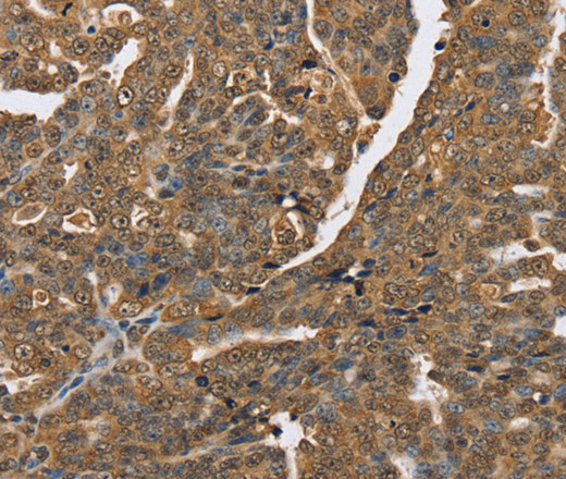 Immunohistochemistry of paraffin-embedded Human cervical cancer tissue using PTPN20 Polyclonal Antibody at dilution 1:40