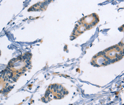 Immunohistochemistry of paraffin-embedded Human colon cancer tissue using TLR8 Polyclonal Antibody at dilution 1:40