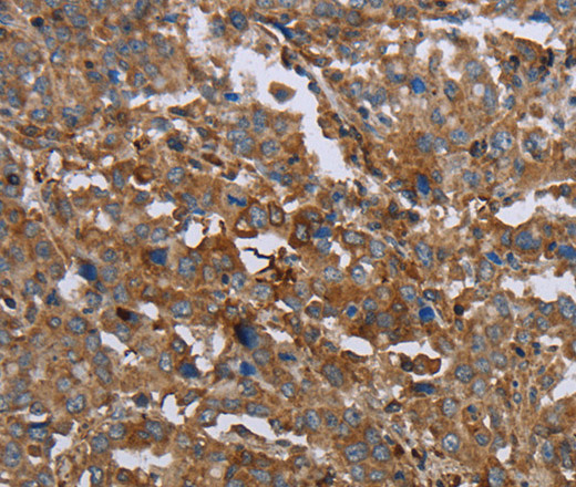 Immunohistochemistry of paraffin-embedded Human liver cancer using GCK Polyclonal Antibody at dilution of 1:40