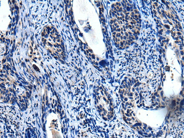 Immunohistochemistry of paraffin-embedded Human cervical cancer tissue  using TRIM23 Polyclonal Antibody at dilution of 1:55(?200)