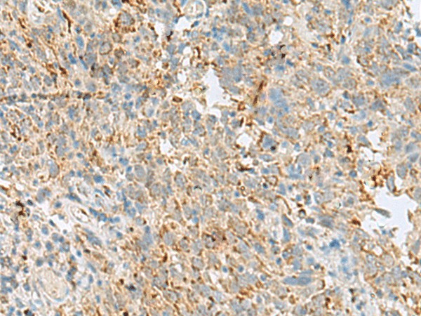 Immunohistochemistry of paraffin-embedded Human cervical cancer tissue  using VDAC3 Polyclonal Antibody at dilution of 1:30(?200)