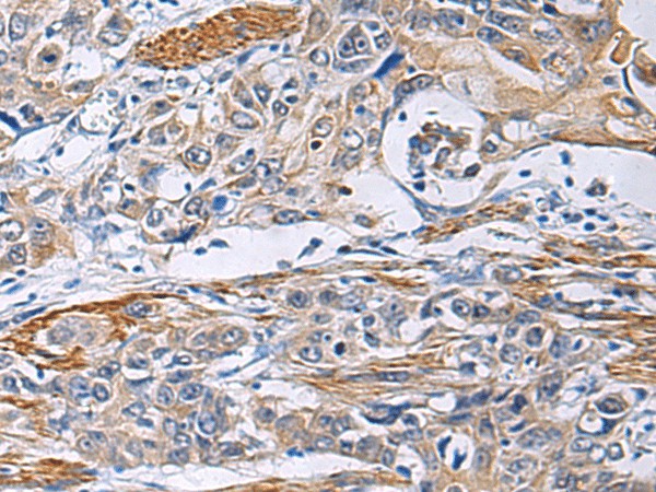 Immunohistochemistry of paraffin-embedded Human esophagus cancer tissue  using FBXO45 Polyclonal Antibody at dilution of 1:40(?200)