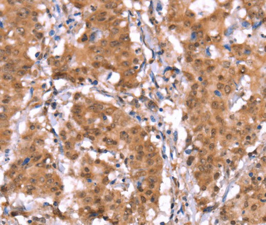 Immunohistochemistry of paraffin-embedded Human gastric cancer tissue using AMER1 Polyclonal Antibody at dilution 1:40