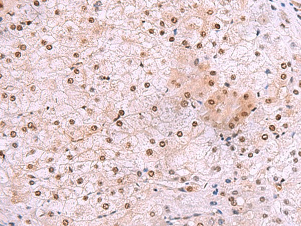 Immunohistochemistry of paraffin-embedded Human liver cancer tissue  using DDI2 Polyclonal Antibody at dilution of 1:50(?200)