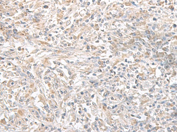 Immunohistochemistry of paraffin-embedded Human liver cancer tissue  using PFKM Polyclonal Antibody at dilution of 1:50(?200)