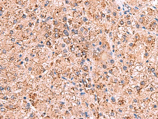 Immunohistochemistry of paraffin-embedded Human liver cancer tissue  using OSBPL2 Polyclonal Antibody at dilution of 1:65(?200)