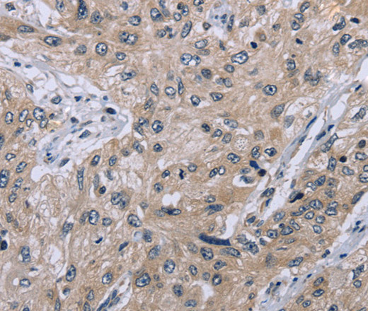 Immunohistochemistry of paraffin-embedded Human esophagus cancer tissue using EID1 Polyclonal Antibody at dilution 1:40