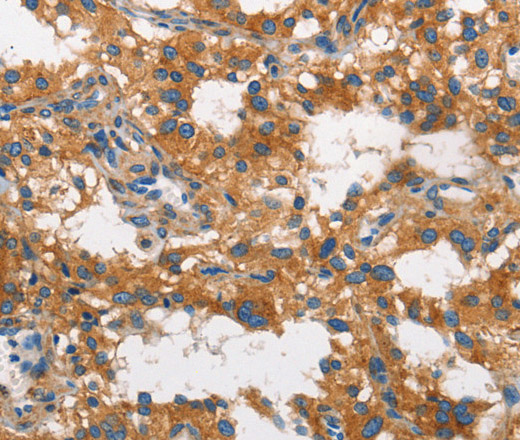 Immunohistochemistry of paraffin-embedded Human thyroid cancer using CLTC Polyclonal Antibody at dilution of 1:60