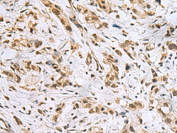 Immunohistochemistry of paraffin-embedded Human gastric cancer tissue  using NABP1 Polyclonal Antibody at dilution of 1:50(?200)