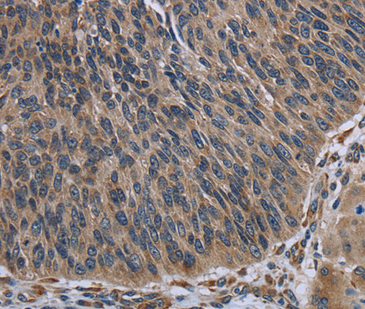 Immunohistochemistry of paraffin-embedded Human lung cancer using AVEN Polyclonal Antibody at dilution of 1:30