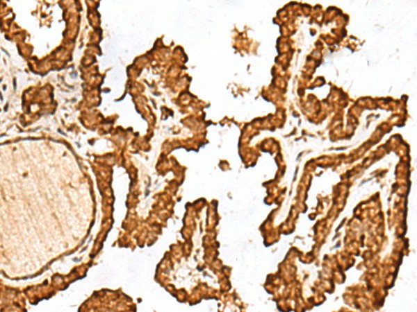 Immunohistochemistry of paraffin-embedded Human thyroid cancer tissue  using FAM200A Polyclonal Antibody at dilution of 1:55(?200)