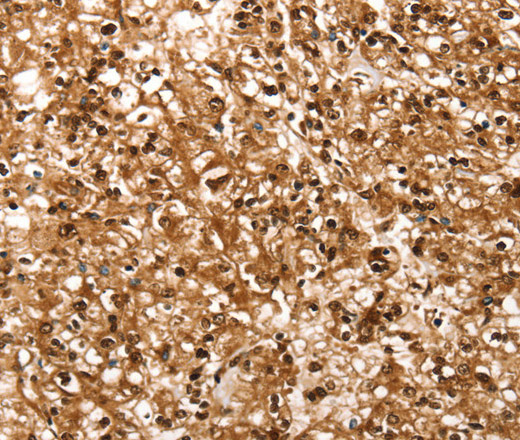 Immunohistochemistry of paraffin-embedded Human prostate cancer using RBM5 Polyclonal Antibody at dilution of 1:30