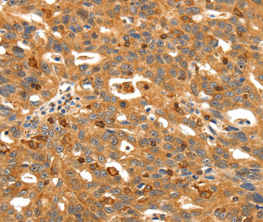 Immunohistochemistry of paraffin-embedded Human liver cancer tissue using SSTR3 Polyclonal Antibody at dilution 1:30