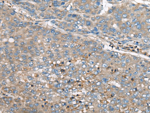 Immunohistochemistry of paraffin-embedded Human liver cancer tissue  using GULP1 Polyclonal Antibody at dilution of 1:65(?200)