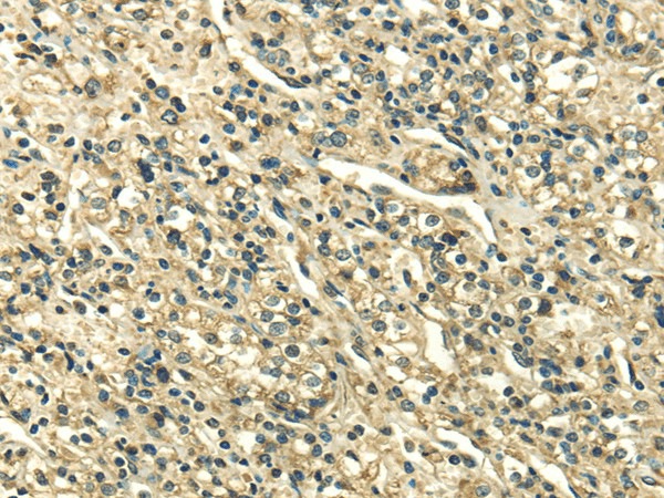 Immunohistochemistry of paraffin-embedded Human prostate cancer tissue using SDF4 Polyclonal Antibody at dilution 1:35