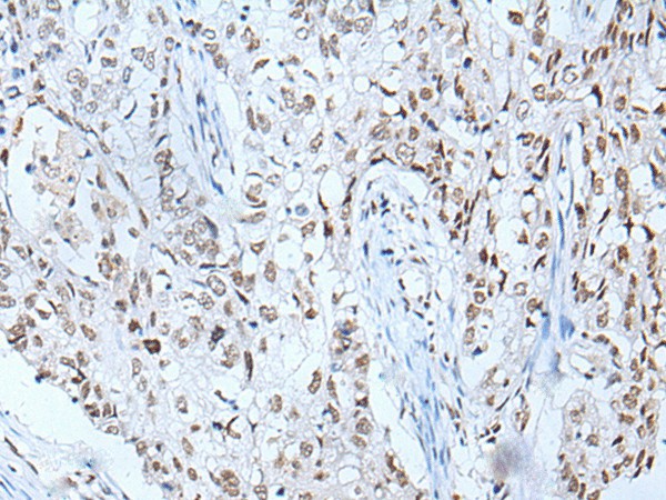 Immunohistochemistry of paraffin-embedded Human lung cancer tissue  using BRD3 Polyclonal Antibody at dilution of 1:60(?200)