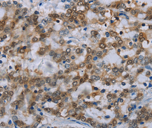 Immunohistochemistry of paraffin-embedded Human liver cancer tissue using MED12 Polyclonal Antibody at dilution 1:40