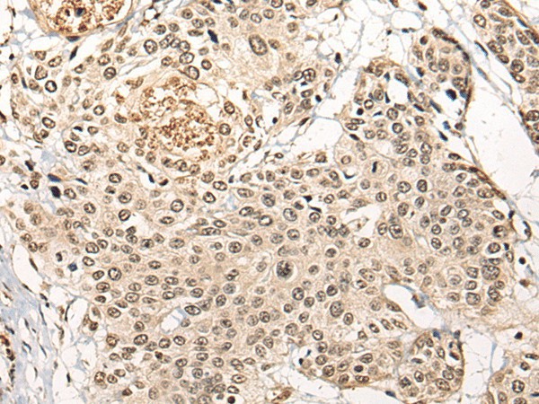 Immunohistochemistry of paraffin-embedded Human prost ate cancer tissue  using BATF Polyclonal Antibody at dilution of 1:45(?200)