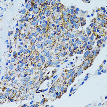 Immunohistochemistry of paraffin-embedded Human lung cancer using MRPL28 Polyclonal Antibody at dilution of 1:100 (40x lens).