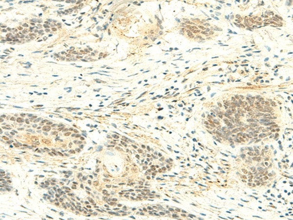 Immunohistochemistry of paraffin-embedded Human esophagus cancer tissue  using ATMIN Polyclonal Antibody at dilution of 1:50(?200)