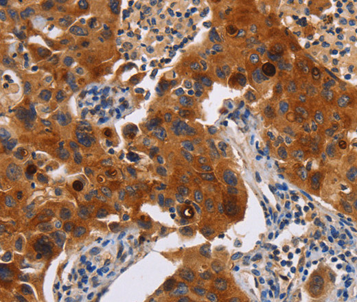 Immunohistochemistry of paraffin-embedded Human lung cancer tissue using MSLN Polyclonal Antibody at dilution 1:40