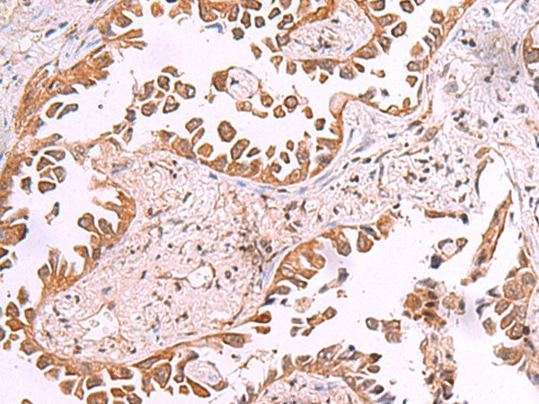 Immunohistochemistry of paraffin-embedded Human lung cancer tissue  using AK9 Polyclonal Antibody at dilution of 1:85(?200)