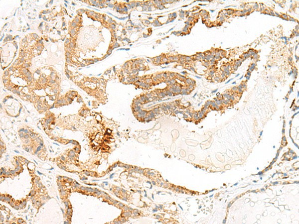 Immunohistochemistry of paraffin-embedded Human thyroid cancer tissue  using HEBP1 Polyclonal Antibody at dilution of 1:60(?200)