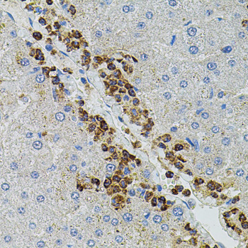 Immunohistochemistry of paraffin-embedded Human liver damage using MMP9 Polyclonal Antibody at dilution of 1:100 (40x lens).