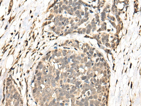 Immunohistochemistry of paraffin-embedded Human thyroid cancer tissue  using BATF Polyclonal Antibody at dilution of 1:40(?200)