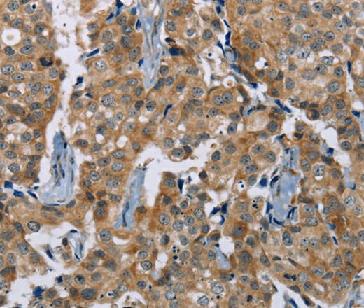 Immunohistochemistry of paraffin-embedded Human breast cancer tissue using PLXNA4 Polyclonal Antibody at dilution 1:50