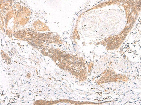 Immunohistochemistry of paraffin-embedded Human esophagus cancer tissue  using DGCR6L Polyclonal Antibody at dilution of 1:70(?200)