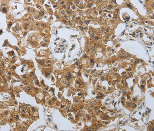 Immunohistochemistry of paraffin-embedded Human lung cancer using PSMD6 Polyclonal Antibody at dilution of 1:40