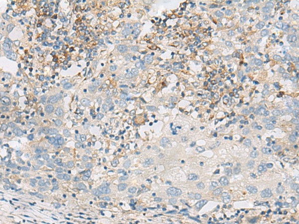 Immunohistochemistry of paraffin-embedded Human cervical cancer tissue  using FERD3L Polyclonal Antibody at dilution of 1:75(?200)