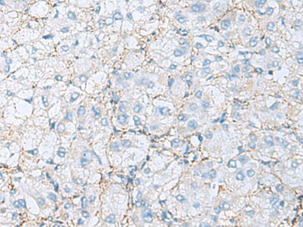 Immunohistochemistry of paraffin-embedded Human liver cancer tissue  using EMILIN1 Polyclonal Antibody at dilution of 1:70(?200)