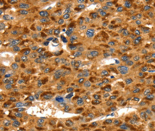 Immunohistochemistry of paraffin-embedded Human liver cancer using TLN1 Polyclonal Antibody at dilution of 1:35