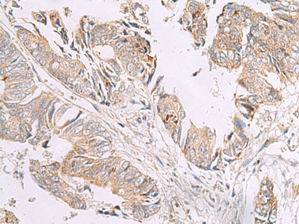 Immunohistochemistry of paraffin-embedded Human colorectal cancer tissue  using GIMAP2 Polyclonal Antibody at dilution of 1:55(?200)