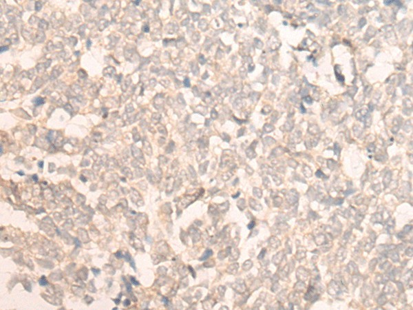 Immunohistochemistry of paraffin-embedded Human lung cancer tissue  using FAN1 Polyclonal Antibody at dilution of 1:30(?200)