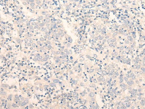 Immunohistochemistry of paraffin-embedded Human cervical cancer tissue  using ADGRE3 Polyclonal Antibody at dilution of 1:35(?200)