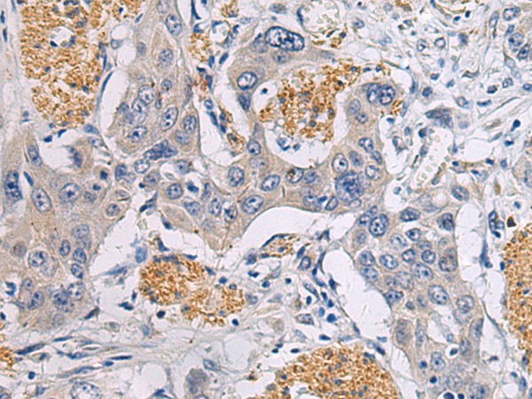 Immunohistochemistry of paraffin-embedded Human esophagus cancer tissue  using CHST3 Polyclonal Antibody at dilution of 1:30(?200)