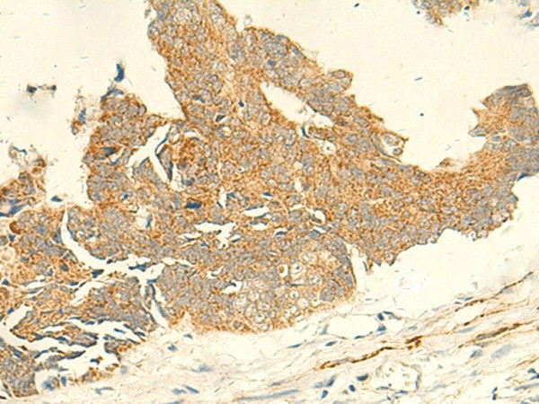 Immunohistochemistry of paraffin-embedded Human colorectal cancer tissue  using TMEM9 Polyclonal Antibody at dilution of 1:50(?200)