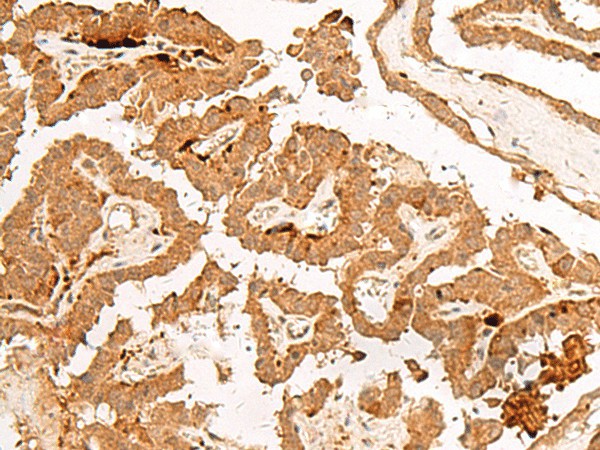 Immunohistochemistry of paraffin-embedded Human thyroid cancer tissue  using POLR2L Polyclonal Antibody at dilution of 1:45(?200)