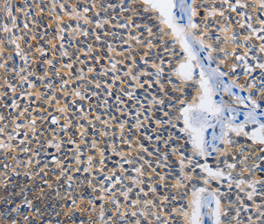 Immunohistochemistry of paraffin-embedded Human lung cancer tissue using MAD2L1BP Polyclonal Antibody at dilution 1:60