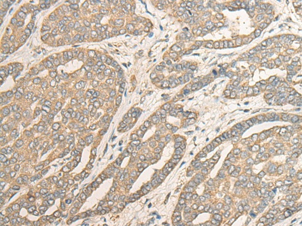 Immunohistochemistry of paraffin-embedded Human liver cancer tissue  using MYOZ2 Polyclonal Antibody at dilution of 1:40(?200)