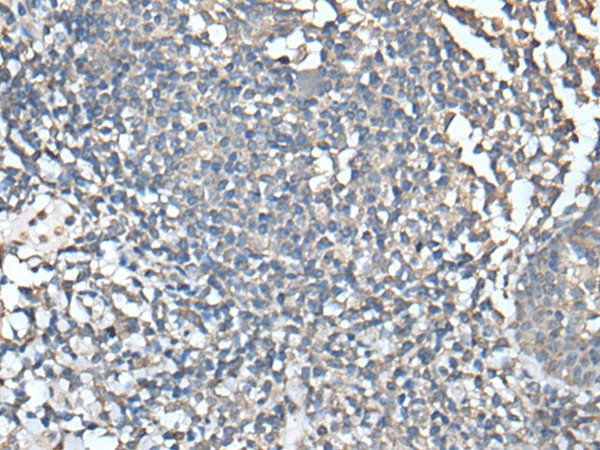 Immunohistochemistry of paraffin-embedded Human tonsil tissue  using UBASH3A Polyclonal Antibody at dilution of 1:50(?200)