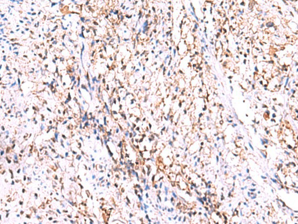 Immunohistochemistry of paraffin-embedded Human cervical cancer tissue  using GMDS Polyclonal Antibody at dilution of 1:70(?200)