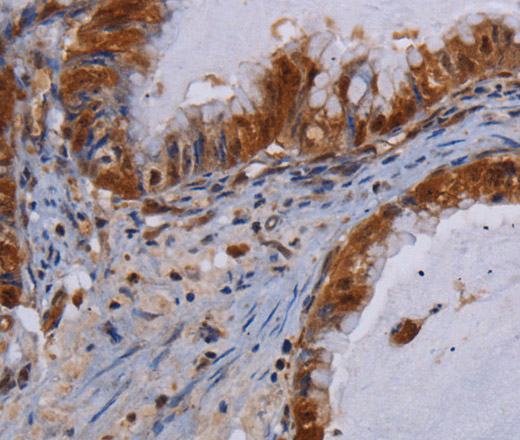 Immunohistochemistry of paraffin-embedded Human esophagus cancer using MECP2 Polyclonal Antibody at dilution of 1:60